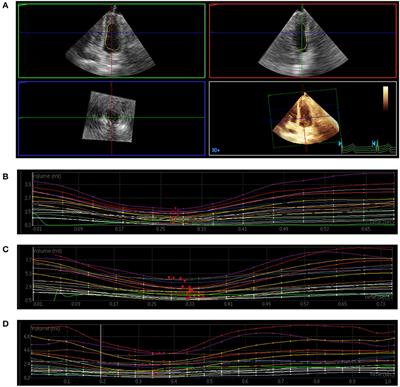 Assessment of Myocardial Dysfunction by Three-Dimensional Echocardiography Combined With Myocardial Contrast Echocardiography in Type 2 Diabetes Mellitus